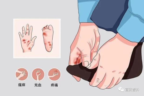 化疗相关不良反应——手足综合征