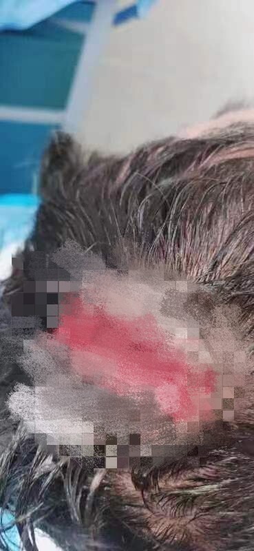 男子被天降老干妈瓶砸破头缝7针，3个月未找到肇事者