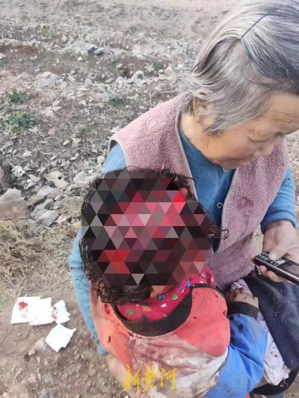 痛心！4岁女童遭3条狗咬掉大半头皮，当地警方回应