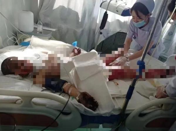 11岁女孩因火灾全身42%烧伤!母亲:爷爷奶奶为救她遇难 11岁女孩因火灾全身42%烧伤!母亲:爷爷奶奶为救她遇难