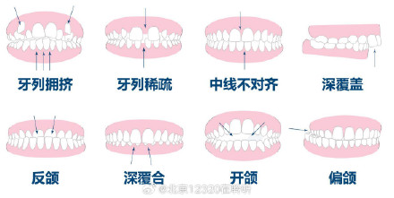 儿童牙齿排列不齐应及时诊治