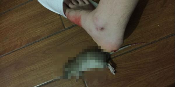 江苏一女子被老鼠咬后反咬回去!医生:当时我也蒙了 江苏一女子被老鼠咬后反咬回去!医生:当时我也蒙了