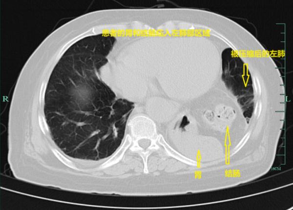 胃和肠都"跑"进肺里!姑娘吓懵:竟因每天的这个习惯… 胃和肠都"跑"进肺里!姑娘吓懵:竟因每天的这个习惯…