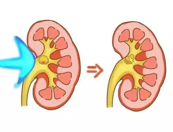 合理饮食预防泌尿结石