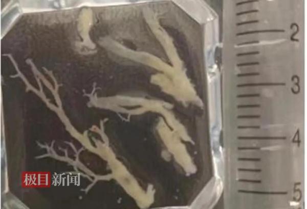 8岁女孩肺里长了棵“树”？元凶竟是……