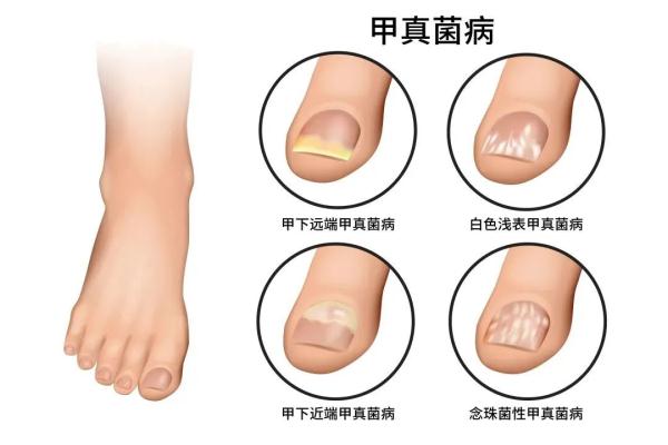 女子美甲后长期不卸，灰指甲竟找上门！医生提醒→