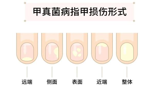 女子美甲后长期不卸，灰指甲竟找上门！医生提醒→