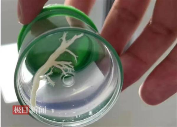 8岁女孩肺里长了棵“树”？元凶竟是……