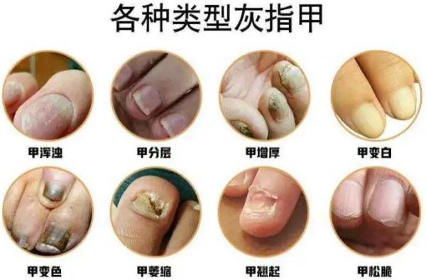女子美甲后长期不卸，灰指甲竟找上门！医生提醒→