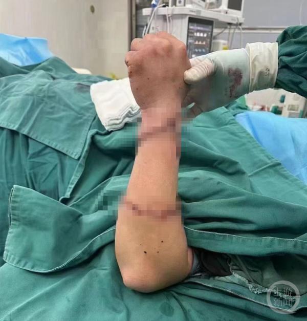手掌小臂断成三截9名医护10小时完成再植，医院：手术成功