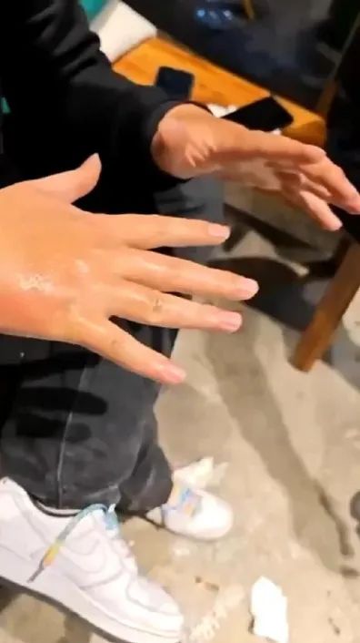 4名顾客在昆明一火锅店用餐时突发意外，致不同程度烧伤！