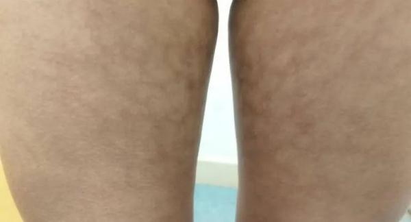 腿上长大片红斑，可能演变成癌症！这个“元凶”，很多贵州人家都有