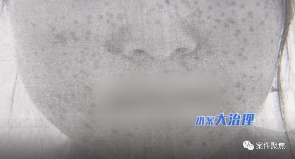 原本白净的上海小姑娘,一下点了242颗斑,成了“麻子”脸? 原本白净的上海小姑娘,一下点了242颗斑,成了“麻子”脸?