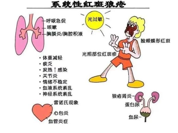 系统性红斑狼疮的日常注意事项