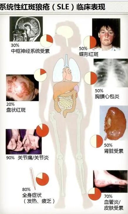 系统性红斑狼疮的日常注意事项