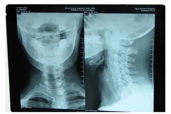 离奇!杭州大伯患怪病,一咳嗽就晕倒!很多人有这个习惯 离奇!杭州大伯患怪病,一咳嗽就晕倒!很多人有这个习惯