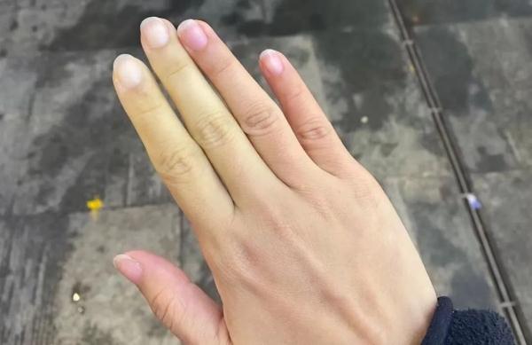小伙手指遇冷就变色,一查吓一跳……医生:千万别不当回事!女性更易中招 小伙手指遇冷就变色,一查吓一跳……医生:千万别不当回事!女性更易中招