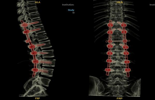 15岁少年梦游从6楼坠落,多处爆裂骨折!上海医生用新技术创造奇迹 15岁少年梦游从6楼坠落,多处爆裂骨折!上海医生用新技术创造奇迹