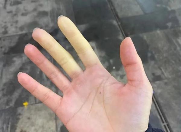 小伙手指遇冷就变色,一查吓一跳……医生:千万别不当回事!女性更易中招 小伙手指遇冷就变色,一查吓一跳……医生:千万别不当回事!女性更易中招