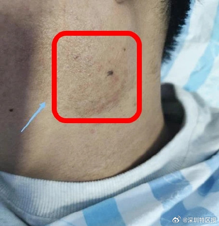 深圳一少年被猫抓伤后脖子出现大肿块 深圳一少年被猫抓伤后脖子出现大肿块