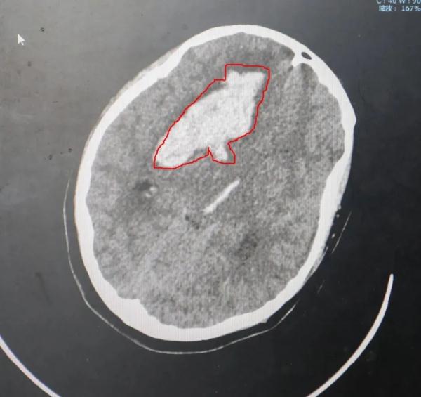 镇江10岁女童突发脑出血!元凶是.... 镇江10岁女童突发脑出血!元凶是....