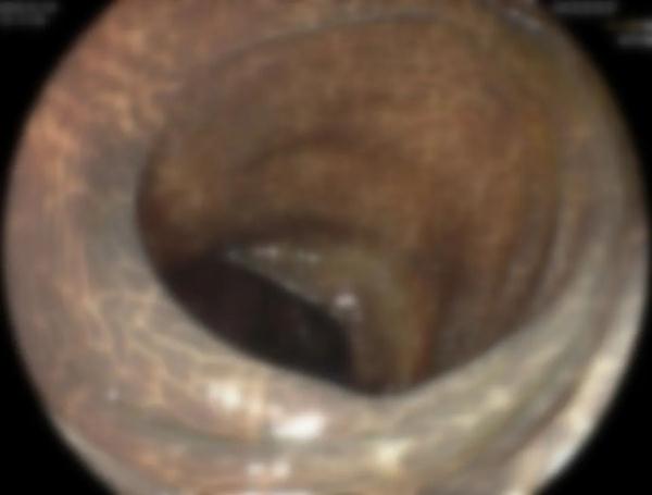 吓人!老人吃了三年“保健品”,肠子变黑似“蛇皮” 吓人!老人吃了三年“保健品”,肠子变黑似“蛇皮”