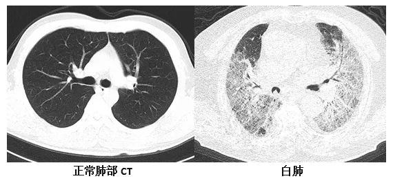 女子硬扛流感10天肺都白了！“白肺”有多危险？能治愈吗？