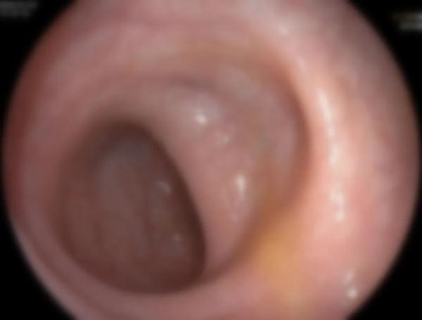 吓人!老人吃了三年“保健品”,肠子变黑似“蛇皮” 吓人!老人吃了三年“保健品”,肠子变黑似“蛇皮”