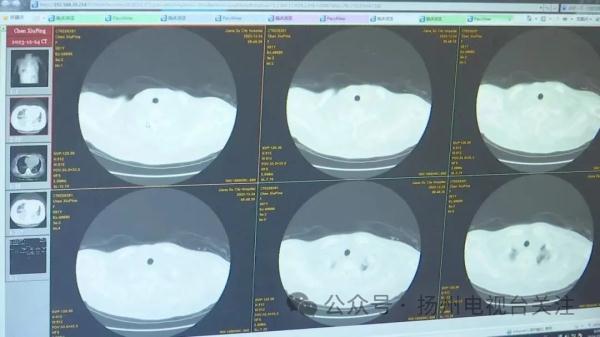女子硬扛流感10天 两个肺全白了！有这些症状拖不得