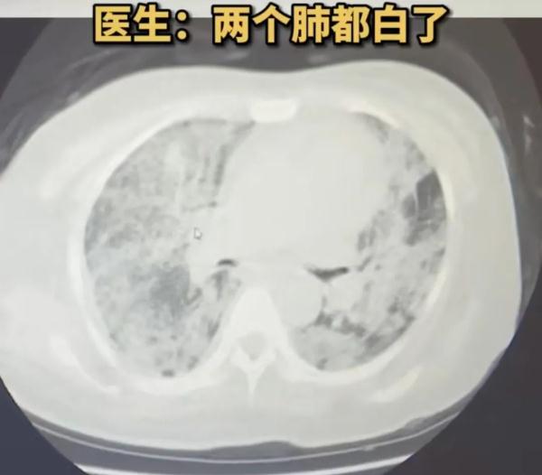 女子硬扛流感10天，两个肺全白了！有这些症状拖不得
