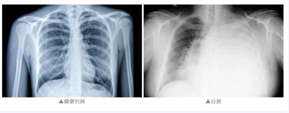 女子硬扛流感10天，两个肺全白了！有这些症状拖不得