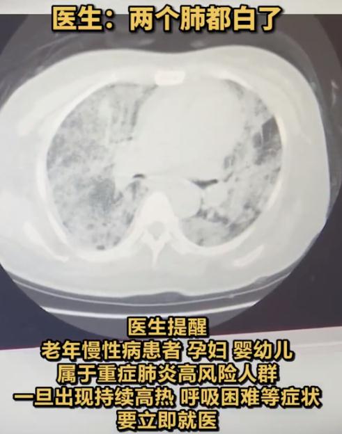 流感硬扛10天,双肺全白!这些症状拖不得→ 流感硬扛10天,双肺全白!这些症状拖不得→