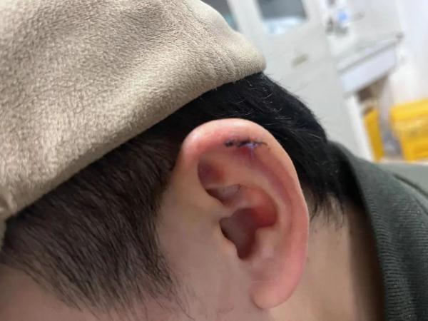 拆线剪怎么拿＂血哗一下冒出来＂！小伙被剪掉块肉 很多人最近也在安排_https://www.jmylbn.com_新闻资讯_第2张