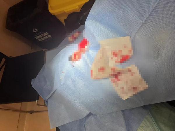 拆线剪怎么拿＂血哗一下冒出来＂！小伙被剪掉块肉 很多人最近也在安排_https://www.jmylbn.com_新闻资讯_第3张