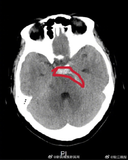 教师妈妈辅导女儿作业脑出血，医生：冬季是脑出血高发季