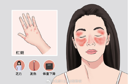 红斑狼疮的症状有哪些? 红斑狼疮的症状有哪些?
