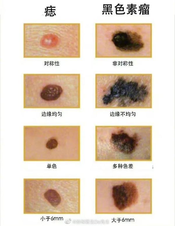 脸上有破口，一查是癌症！身上长出这东西，千万盯紧……