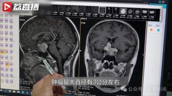 21岁女生每月来3次月经!病因竟然在大脑…… 21岁女生每月来3次月经!病因竟然在大脑……