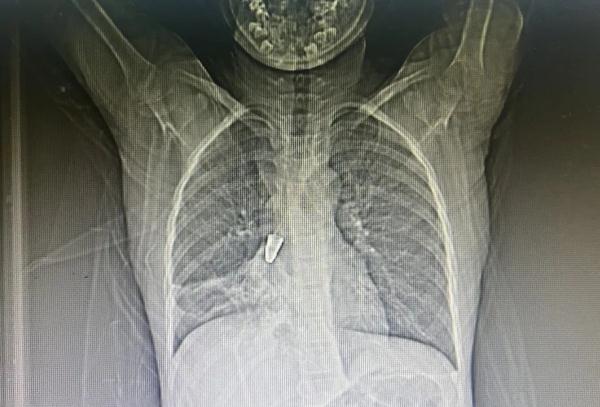 连夜手术！武汉医生提醒：近期连发5起，千万要当心