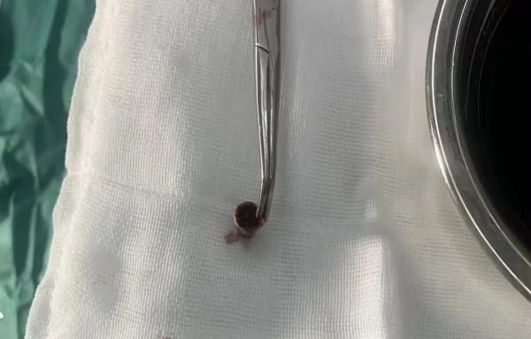 连夜手术！武汉医生提醒：近期连发5起，千万要当心