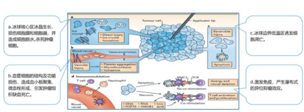 不用开刀？这种技术可以“冻死”乳腺肿瘤！