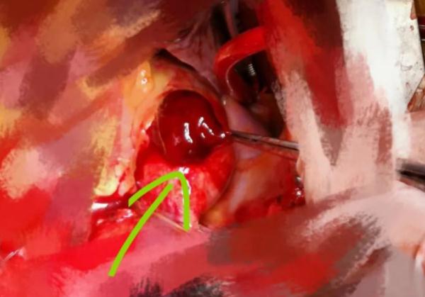 气到心裂、 抢救7小时！37岁宝妈辅导功课差点送了命