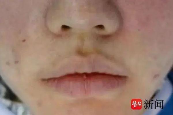 注射“胶原蛋白”后她“烂脸”了……美容变“毁容”