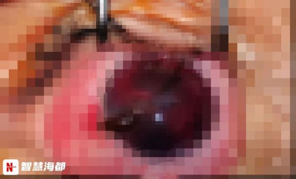 事发泉州！女童拆快递时不慎刺伤眼 画面触目惊心