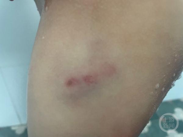 家长称4岁男童被狗咬伤，狗主人称监控显示没有咬