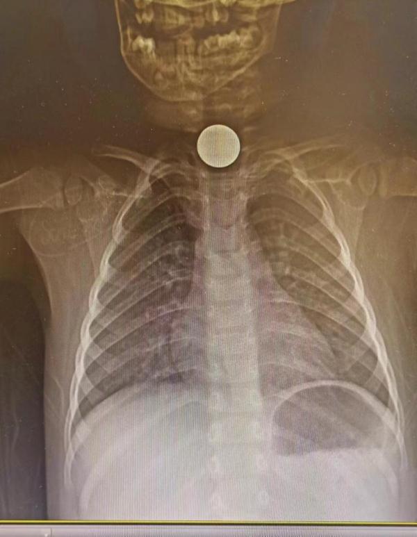 警惕丨银川家长注意，一天发生两起意外，谨防孩子误吞这些东西！