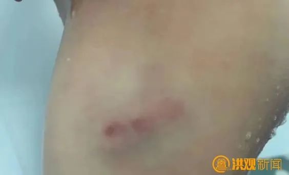 突发！4岁男孩被狗咬伤
