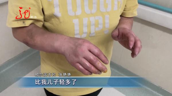 哈尔滨14岁男孩全身烧伤，妈妈痛哭：“是我没看好他！”