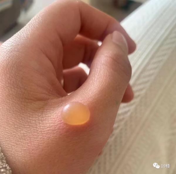 知名女演员自曝：“持续刺痛”！近期很多人中招