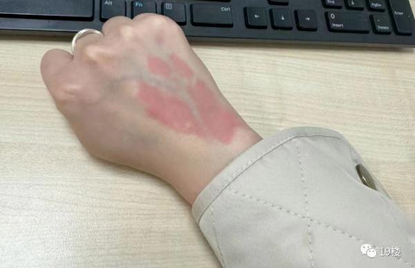 知名女演员自曝：“持续刺痛”！近期很多人中招